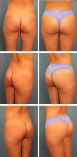 brazilian butt lift surgery in Tampa florida