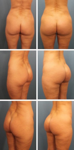 lakeland florida brazilian butt lift patient