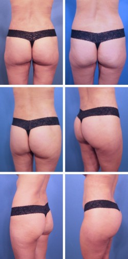 plant city florida butt lift surgery