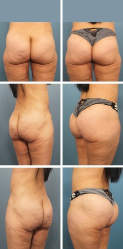 brazilian butt lift tampa florida patient