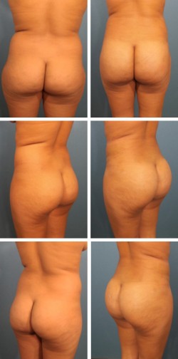 brazilian butt lift in Brandon Florida patient