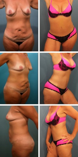 38 y/o Brandon Fl Mommy Makeover with Tummy Tuck , Breast Augmentation and Butt Lift .