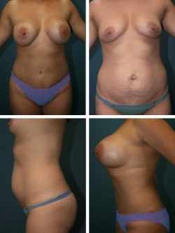 Cambio de imagen de mamá con abdominoplastia y aumento de senos en Tampa, FL