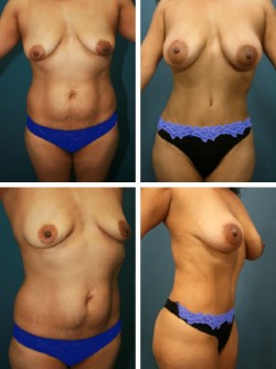 Riverview, Fl Mommy Makeover with Tummy Tuck