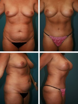 Brandon Fl Mommy Makeover con Abdominoplastia con Lipo y Aumento de Senos