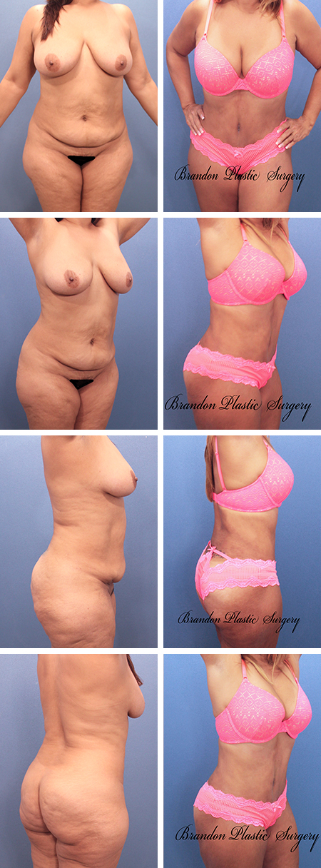 38 y/o Tummy Tuck Plant City Florida with hourglass technique body sculpting with waist cinching and butt contouring