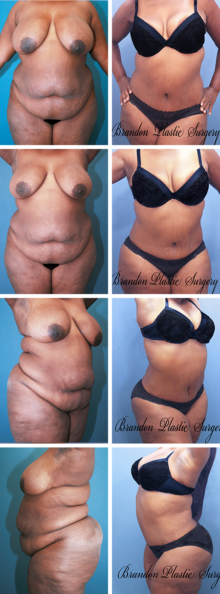 39 y.o Tampa Bay Tummy Tuck with Vaser lipo sculpture and corset waist cinching