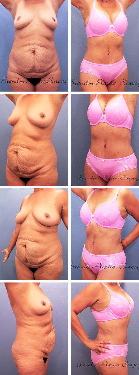 47 y/o Tummy Tuck Apollo Beach Gibsonton Liposuction with extensive abdominal corset tightening and Vaser body contouring