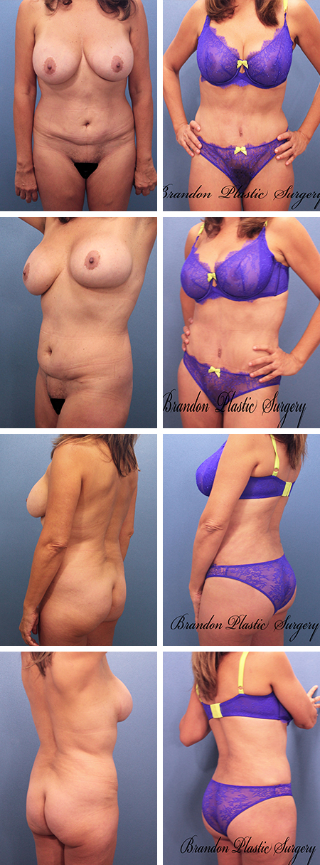 51 y/o Tummy Tuck Bartow Mulberry Florida with fat transfer Brazilian Butt Lift and circumferential hourglass body contouring