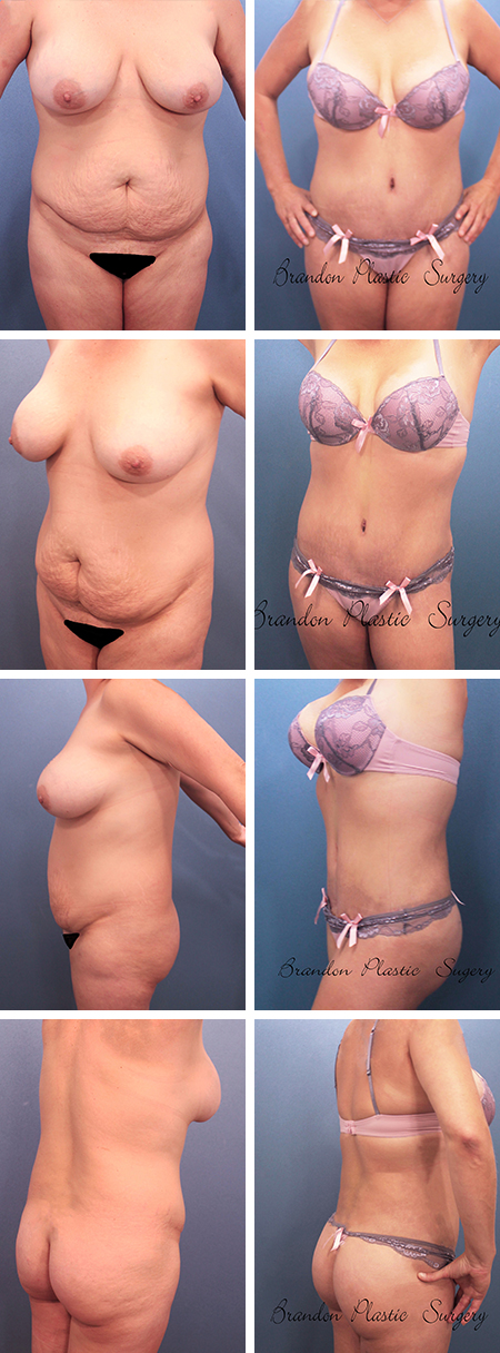 47 y/o Hourglass Tummy Tuck Lakewood Ranch FL. with corset waist cinching , Vaser Liposculpture and Brazilian Butt enhancement