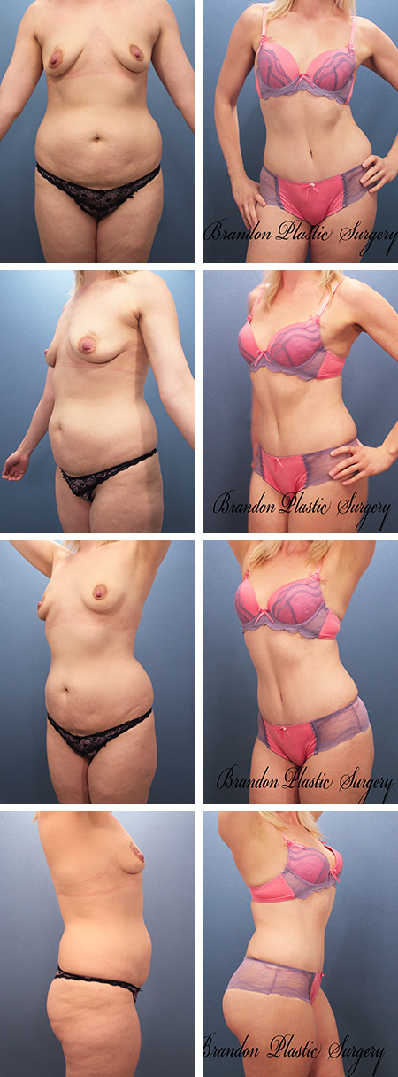 35 y/o Hourglass Tummy Tuck Winter Haven Auburndale Florida with corset abdominal plication Lipo sculpture of hips thighs and flanks and Brazilian Butt Lift.