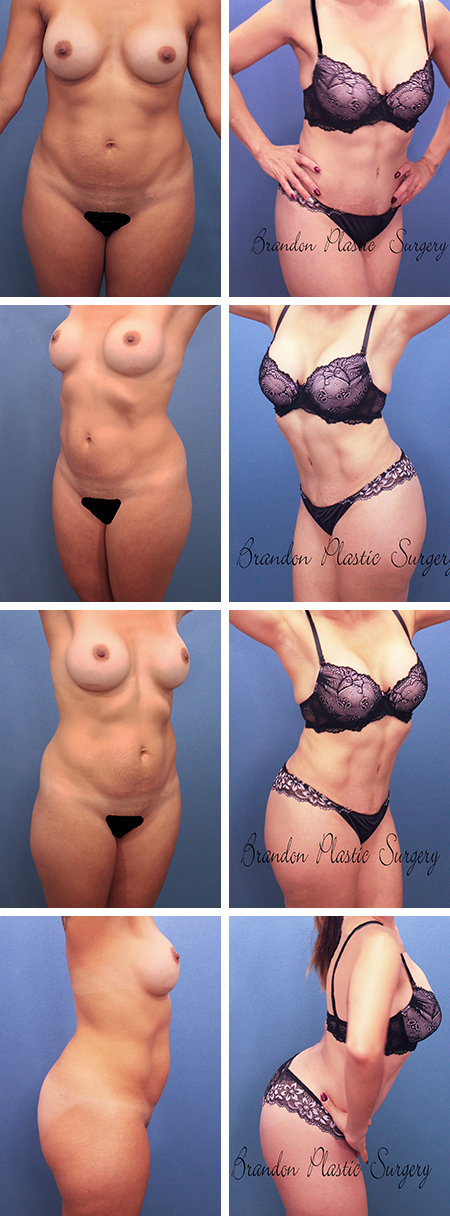 27 y/o Hourglass 360 Tummy Tuck Ruskin Sun City Florida with Butt contouring and Vaser Lipo sculpture