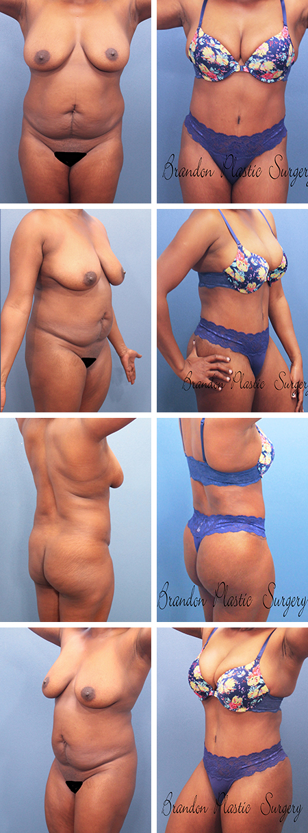 42 y/o Hourglass Tummy Tuck Brooksville Spring Hill Florida with Vaser assisted Liposuction and Butt enhancement following the natural muscular contours