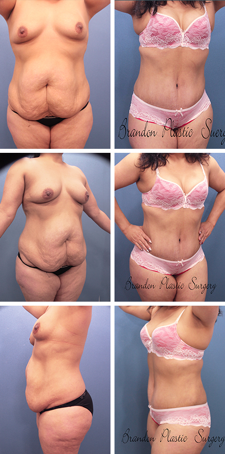 44 y/o Vaser Lipo Abdominoplasty with corset waistline reduction and contouring for Tummy Tuck Celebration Kissimmee Fl