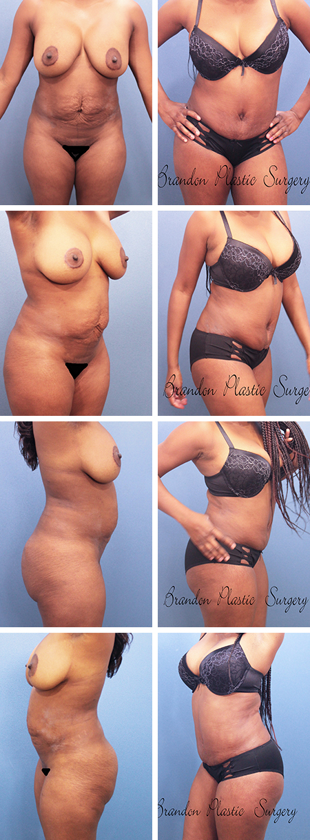 33 y/o abdominal torso narrowing and ultrasound assisted Vaser lipo sculpture for Temple Terrace Tummy Tuck