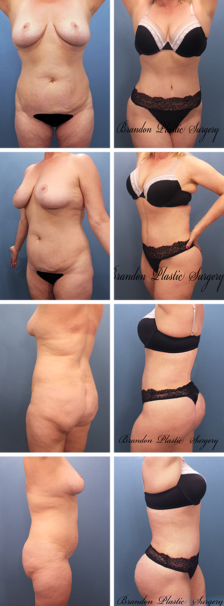 35 y/o Hourglass Lipo abdominoplasty technique of Vaser lipo sculpture and butt enhancement to create a totally new body silhouette Tummy Tuck Largo Seminole Fl