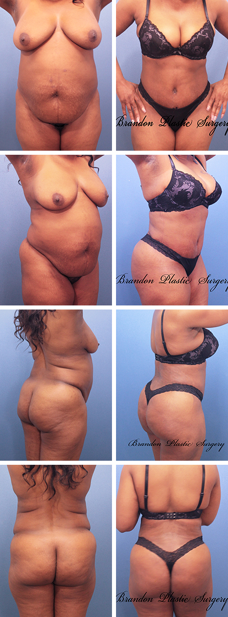 41 y/o Tummy Tuck Wesley Chapel incorporating extensive Lipo Sculpture with Brazilian Butt Lift enhancement for a strikingly provocative and muscular body contour.