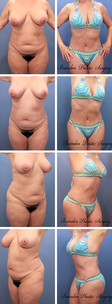 52 y/o Hourglass Tummy Tuck Pinellas County Florida with abdominal etching , butt enhancement and flank and thigh contouring for 360 degree sculpted appearance.
