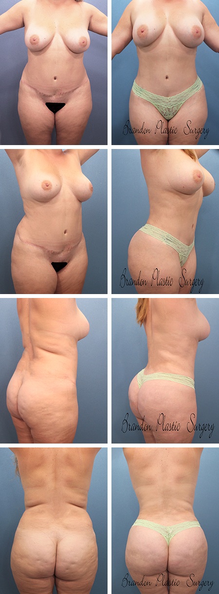 39 y/o Hillsborough Tummy Tuck revision with waist sculpting and butt reshaping