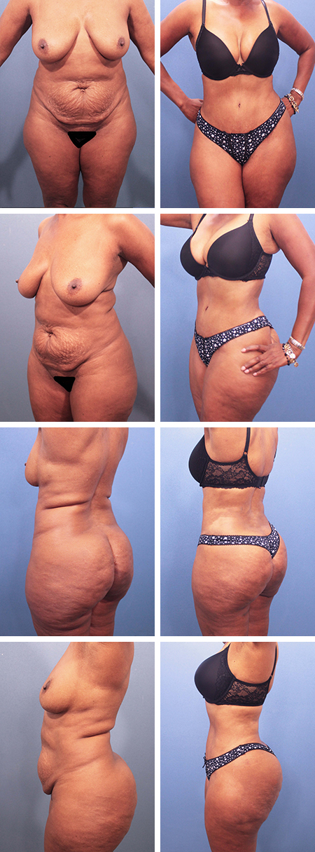 55 y/o Tummy Tuck Clearwater Fl with Vaser Lipo sculpting and Butt contouring