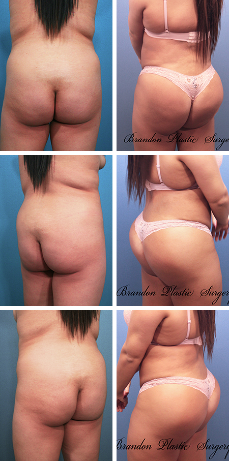 22 y/o Brazilian Butt Lift Hillsborough County utilizing ultrasonic Vaser technique to sculpt and redefine body contours
