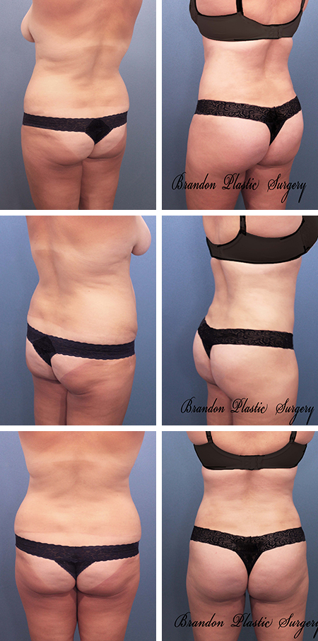 34 y/o New Tampa Brazilian Butt Lift with 700 cc of fat transfer to buttock cheeks . Liposuction of flanks back waist thighs and knees provides a sculpted body transformation