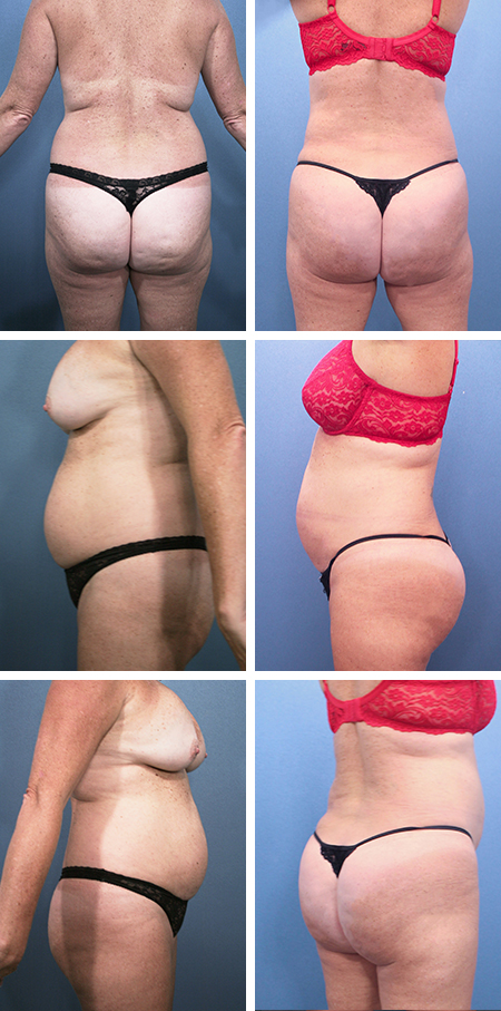 43 y/o Brazilian Butt Lift Lake Wales with Lipo sculpture of offending back rolls , flanks and waist for a rejuvenated curvy silhouette .