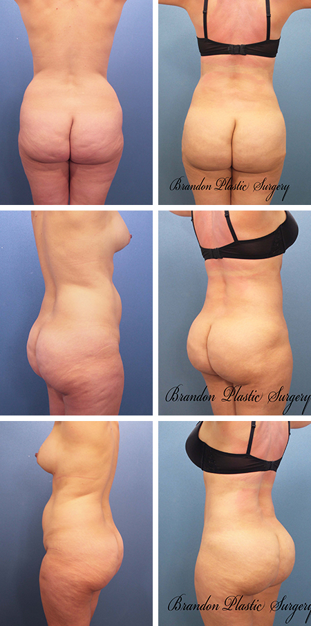 53 y/o Brazilian Butt Lift Largo Fl with Vaser ultrasonic sculpting and transfer of 700 cc of fat to butt cheeks.