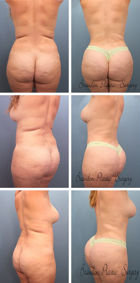45 y/o Tampa Bay Brazilian Butt Lift with Vaser Lipo sculpture of offending lipodystrophy and 950 cc of fat transfer to the derriere.