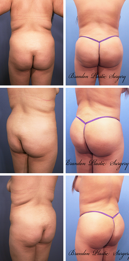 26 y/o Florida Brazilian Butt Lift with ultrasonic Vaser Lipo sculpting and butt enhancement with 900 cc of fat