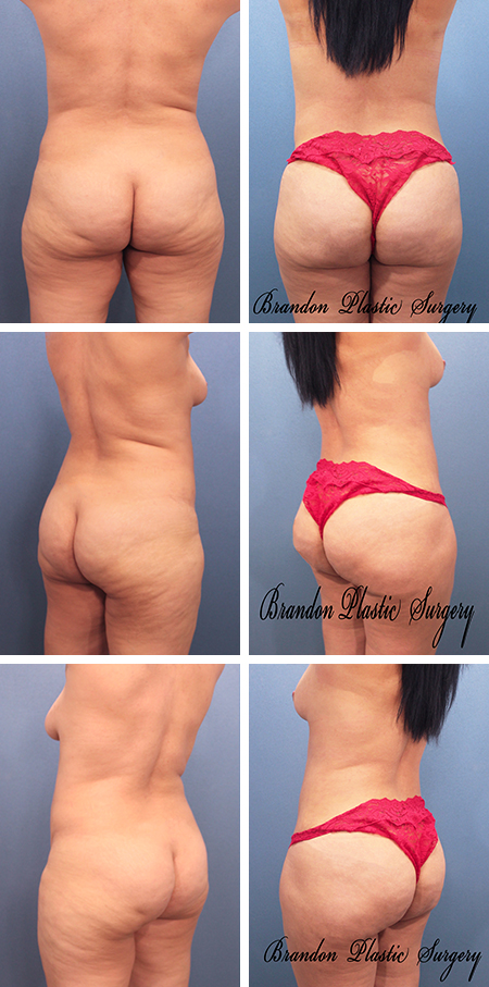 39 y/o Brazilian Butt Lift Bartow Mulberry with smoothing of cellulite and contour irregularities and Lipo sculpture of surrounding waist ,thigh, hip , flank and back fat .