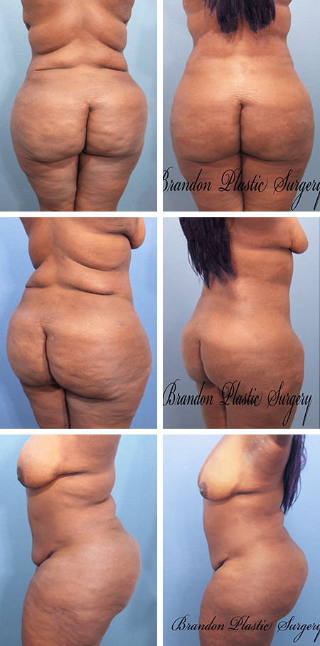 27 y/o Brazilian Butt Lift Ruskin Apollo Beach Fl with removal of excessive back and flank rolls with ultrasonic Vaser Lipo sculpture .