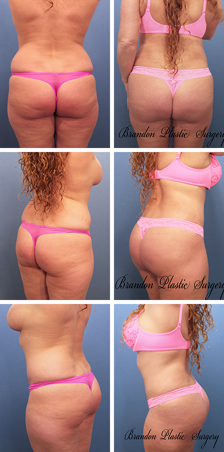 28 y/o Brazilian Butt Lift Melbourne Fl in combination with a Hour glass Tummy Tuck and circumferential body Vaser Lipo sculpture .