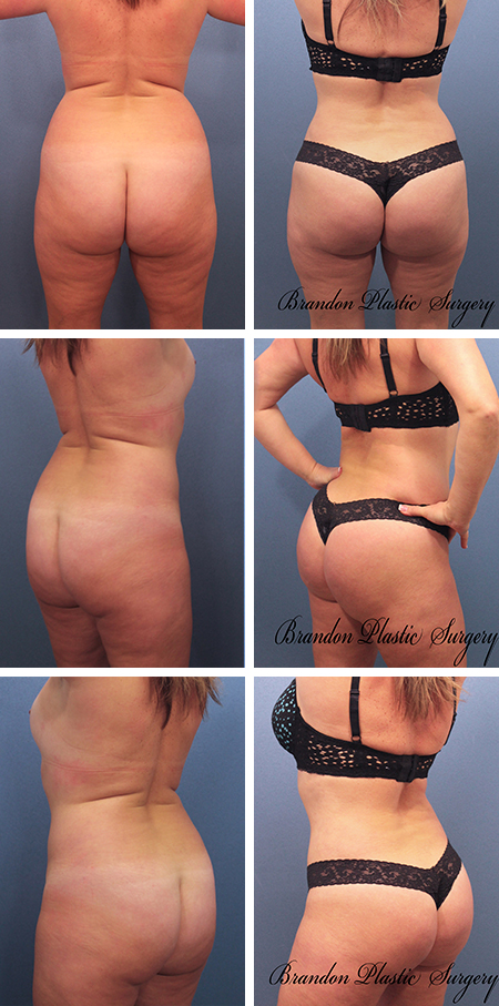 33 y/o Brazilian Butt Lift Brandon Florida with lipo sculpting of waist thighs flanks and hips.