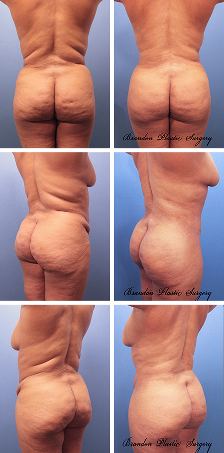 33 y/o Brazilian Butt Lift Lakewood Ranch Fl with contouring of back and flank rolls combined with a Hourglass Tummy Tuck