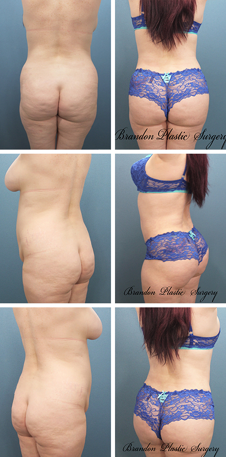 28 y/o Avon Park Sebring Fl Brazilian Butt lift with 700 cc fat enhancement