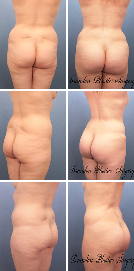 29 y/o Brazilian Butt Lift Parrish Palmetto Fl with 900 cc of fat transfer