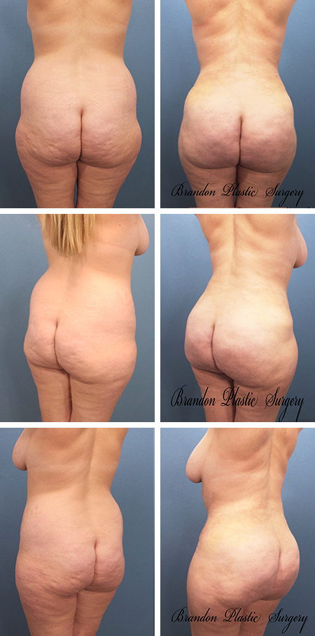 47 y/o Brazilian Butt Lift Auburndale Haines City Fl with 700 cc fat transfer and elimination of excessive saddle bags, hip rolls and muffin top fat by ultra-sonic assisted Liposuction.