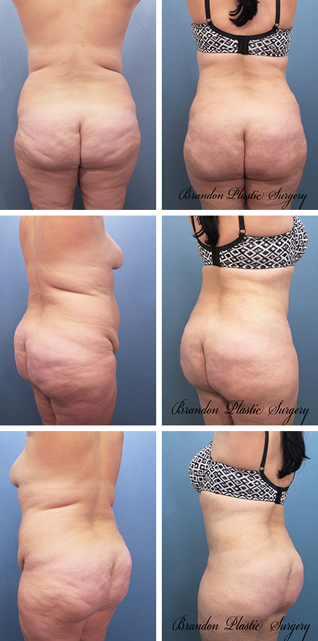 29 y/o Brazilian Butt Augmentation Zephyrhills Dade City with cellulite reduction and waist , back and thigh Lipo sculpting