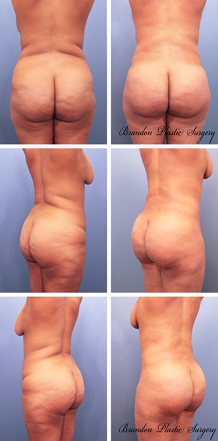 43 y/o Brazilian Butt Lift Lutz Land of Lakes Fl with 800 cc of fat transfer for a more rounded provocative derriere