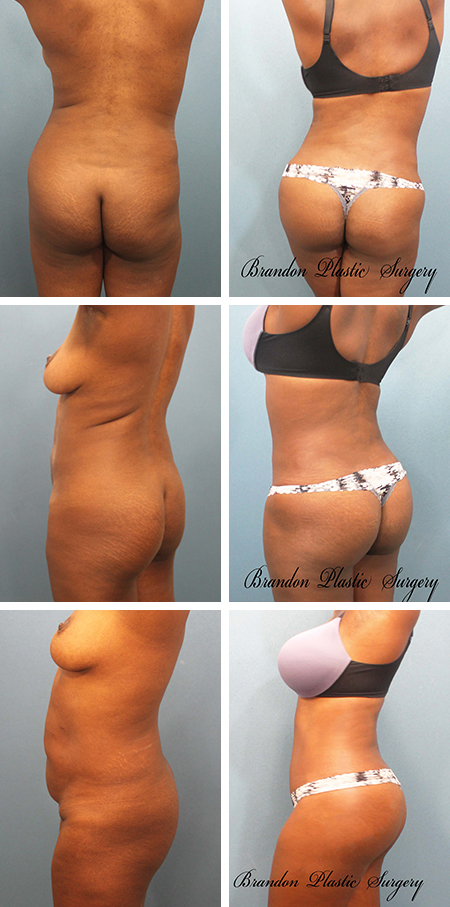 26 y/o Butt Lift Brandon Fl. with Lipo sculpture of flanks , hip back, waist, and thighs to create a curvy sexy silhouette .