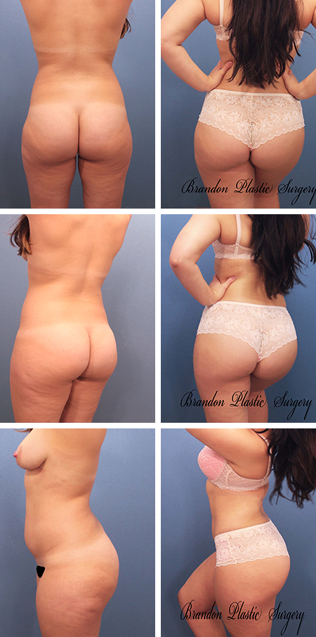 33 y/o Butt Lift Winter Haven with Lipo Sculpting of misplaced fatty lipodystrophy with transfer to the derriere