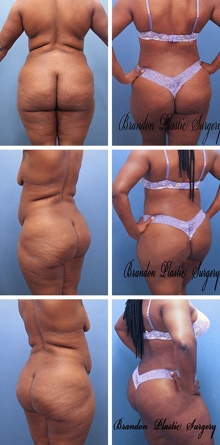 41 y/o Tampa Bay Brazilian Butt Lift performed with a Hour Glass Tummy Tuck . Diet resistant tummy and back fat was removed and used to enhance , smooth and define the butt cheeks .