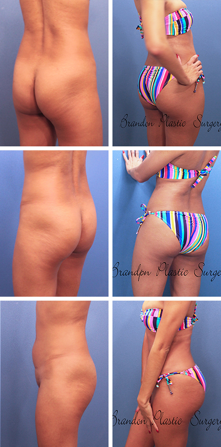 39 y/o Butt Lift Brandon Fl showing heightened definition of the buttock cheeks achieved with Vaser Lipo sculpture