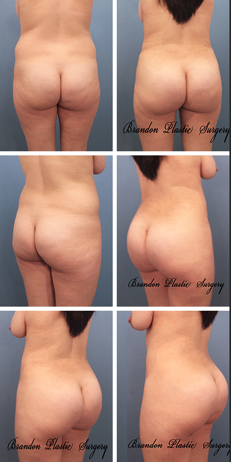 26 y/o Celebration Kissimmee Fl with abdominal and back contouring and 900 cc of fat transfer butt enhancement