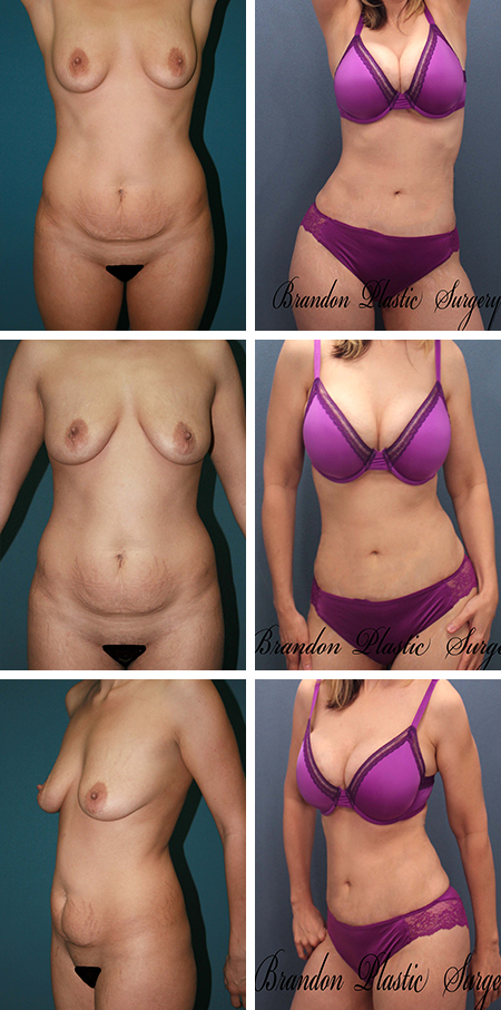 35 y/o Mommy Makeover Polk County Fl. Tummy Tuck with 425 cc silicone breast implants