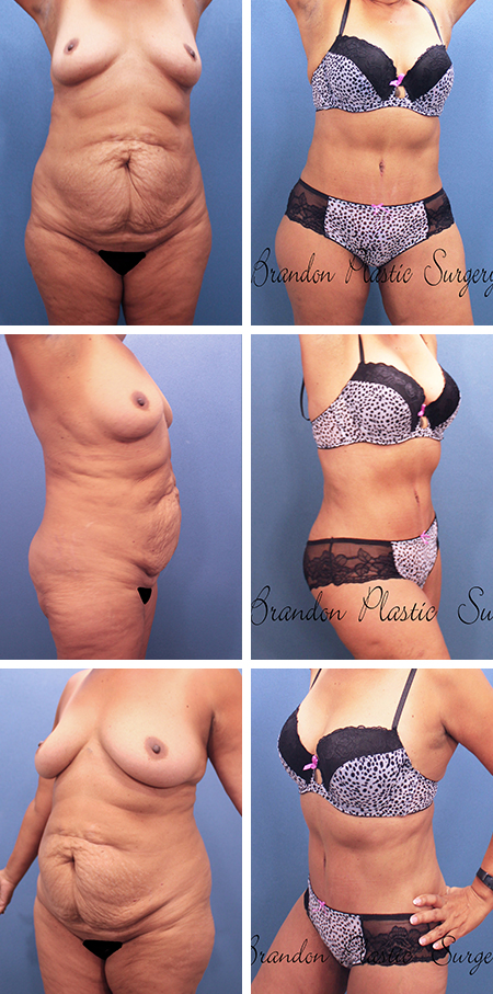 47 y/o Mommy Makeover Ruskin Palmetto Fl. Tummy Tuck with corset waist tightening and circumferential Lipo Sculpting