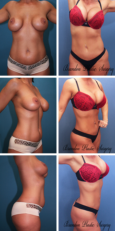 34 y/o Mommy Makeover Winter Haven Florida with silicone Breast Augmentation and circumferential high definition Vaser ultrasonic Liposuction