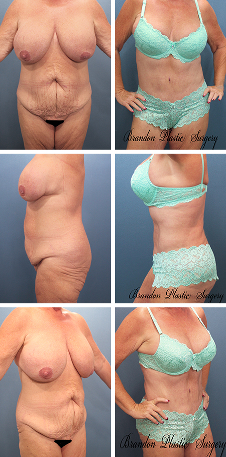 47 y/o Mommy Makeover Tampa Bay Hourglass Tummy Tuck with corset waist cinching , Lipo sculpting , and removal of stretch marks .