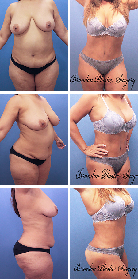 30 year old Mommy Makeover Brandon Florida with Vaser Lipo sculpting and fat transfer Butt Enhancement